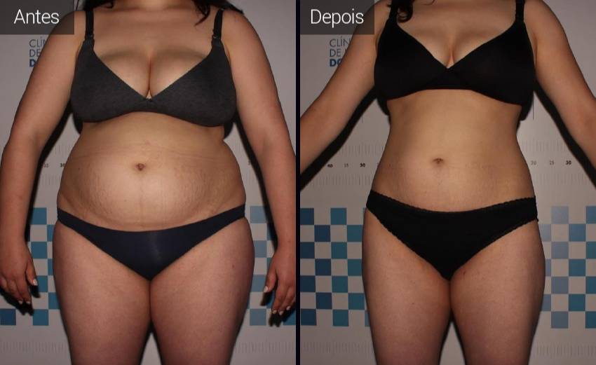 resultados - abdomen - flancos - coxa - vista frontal